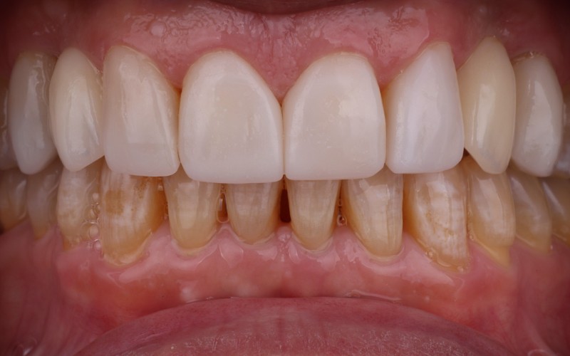 Después: Implantes, coronas individuales y carillas ProDontics