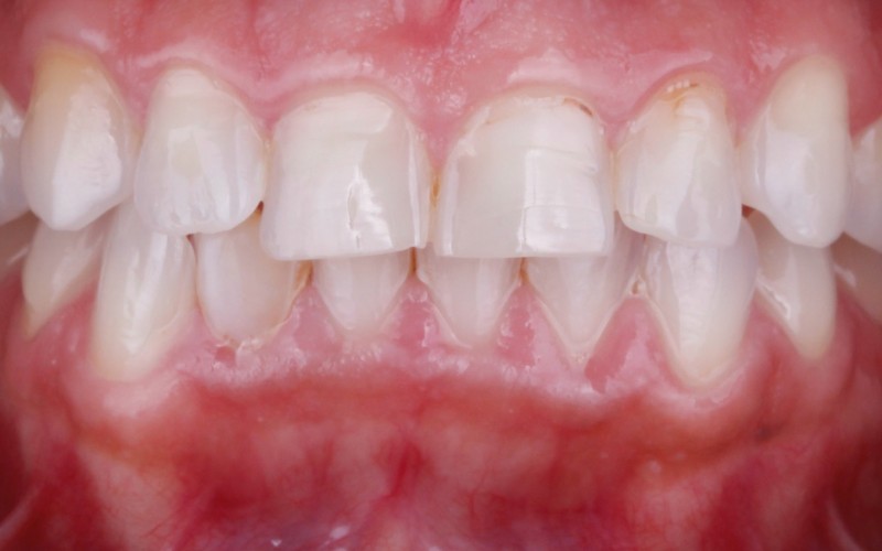 Antes: Apiñamiento y desgaste dental