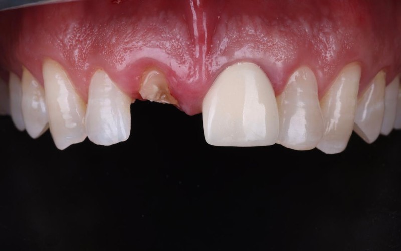 Antes: Fractura dental con pérdida de estructura coronal