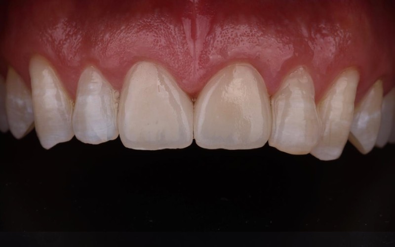 Después: Corona nueva tras fractura dental, endodoncia y reconstrucción