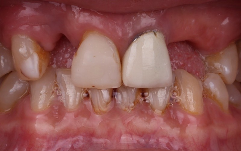 Antes: Ausencia de tres dientes anteriores