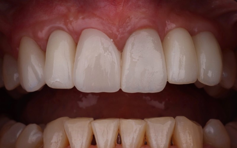 Después: Implantes y coronas nuevas en dientes anteriores ProDontics