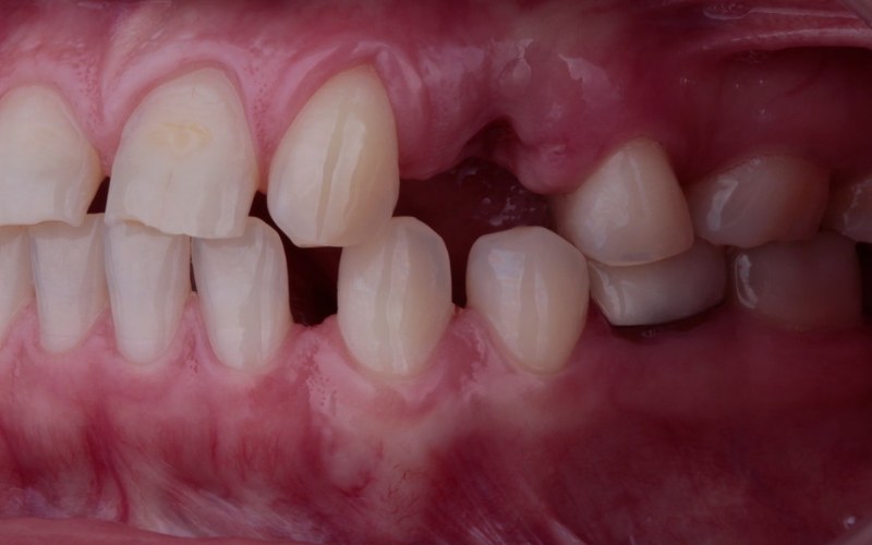 Antes: Espacios y desgaste dental con contraindicación médica para implantes