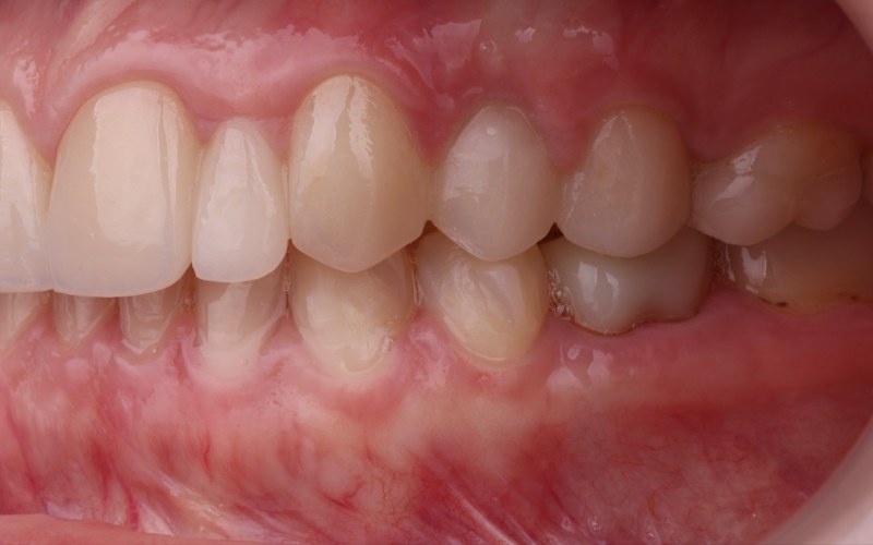 Después: Rehabilitación con prótesis fija sobre dientes naturales