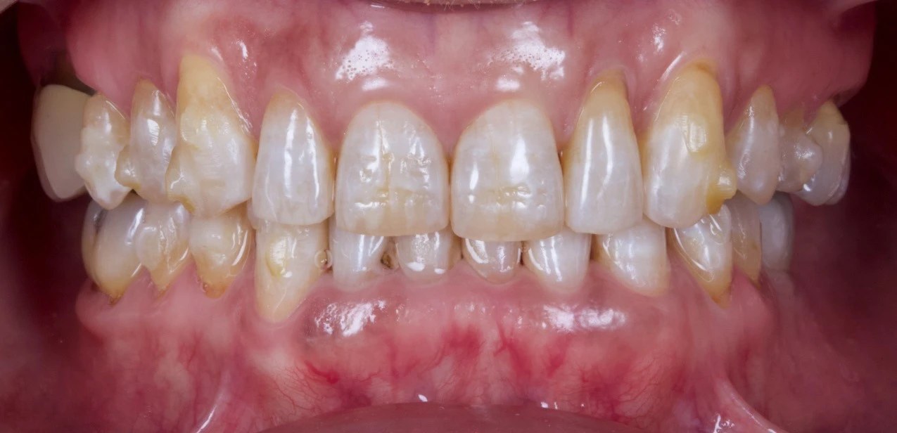 Antes: Sobremordida, apiñamiento anteroinferior y recesión gingival