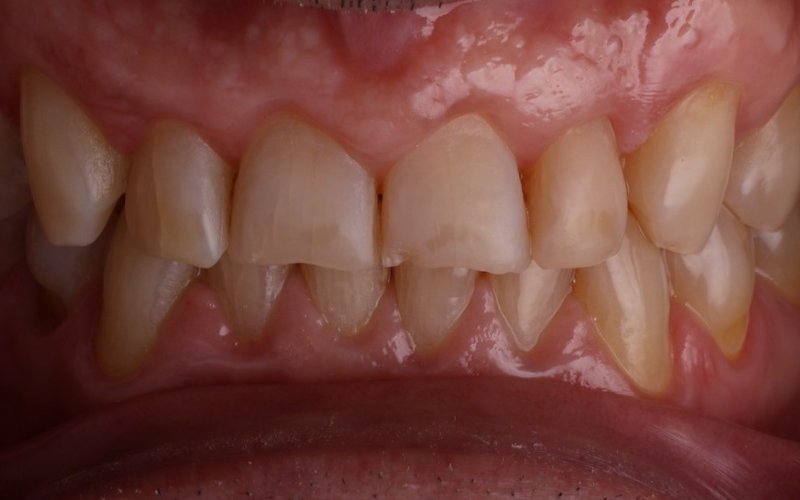 Antes: Dientes con desgaste y restauraciones previas a rehabilitar